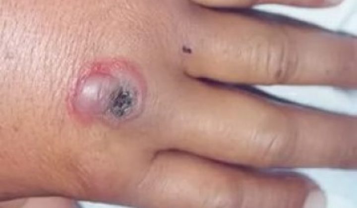 В Дагестане пятеро госпитализированы с подозрением на сибирскую язву